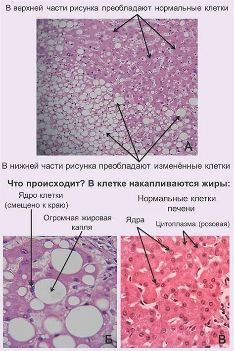 Рис 6 Отложения жира в клетках печени Эти изменения более характерны для - фото 8
