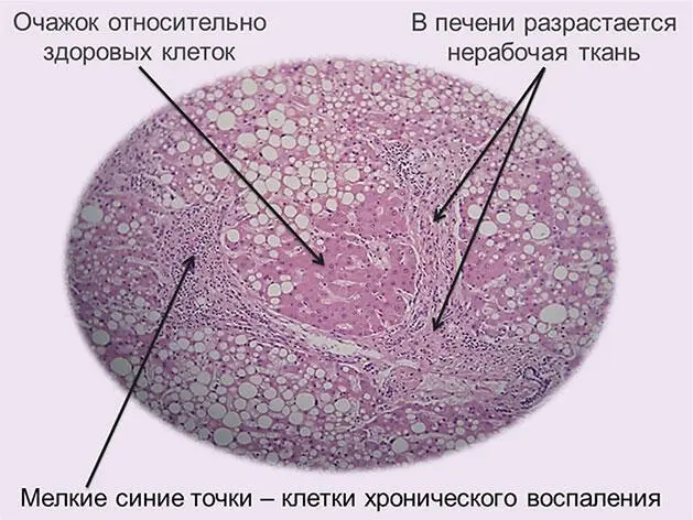 Рис 7 Разрастания нерабочей ткани в печени скопления клеток хронического - фото 9