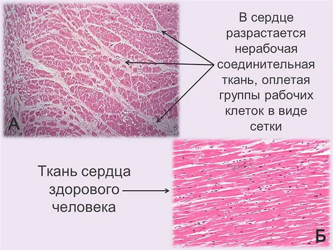Рис 9 А Сердце в сеточку разрастание нерабочей ткани среди рабочих - фото 11