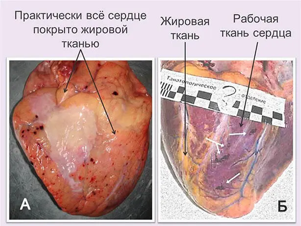 Рис 10 А Отложение большого количества жировой ткани в наружной оболочке - фото 12