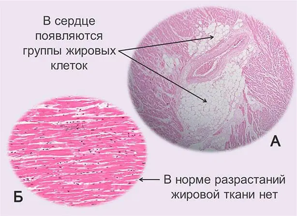 Рис 11 А Очаги жировой ткани в сердце Выглядят как скопления белых пустых - фото 13