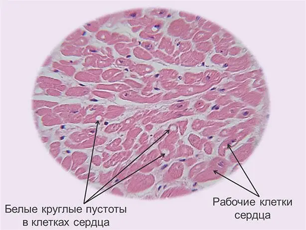 Рис 12 Круглые пустоты в некоторых рабочих клетках сердца отложение лишних - фото 14