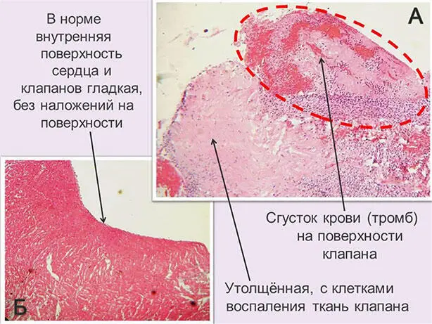 Рис 13 Эндокардит с наличием тромба на поверхности створок клапана сердца - фото 15