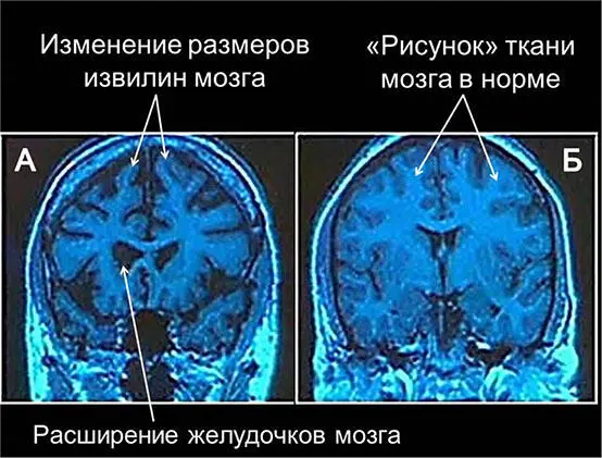 Рис 15 А компьютерная томограмма головного мозга 43летнего мужчины - фото 17