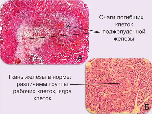 Рис 17 Панкреонекроз гибель клеток поджелудочной железы 17А в центре - фото 19
