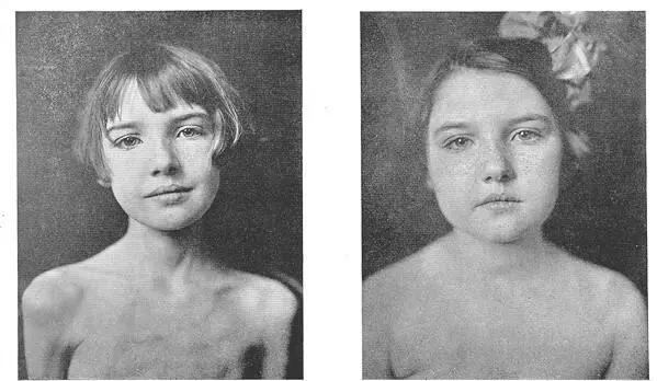 Рис 59 1922 год девочка с диабетом 1го типа до и после лечения инсулином И - фото 48