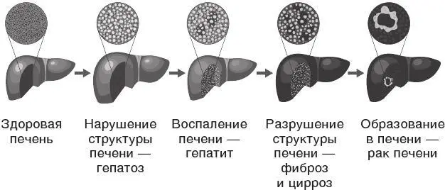 Рис 9 Ухудшение состояния печени Иногда еще до начала гибели клеток печени мы - фото 12