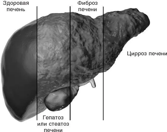 Рис 10 Стадии разрушения печени Собственно цирроз это переломный момент в - фото 13