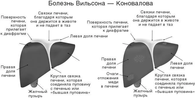 Рис 52 Очаги накопления меди в печени В норме избыток меди выводится с желчью - фото 76