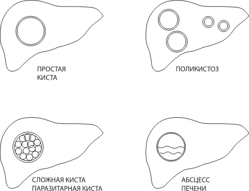 Рис 61 Виды образований в печени Иногда случается так что в печени сразу или - фото 89