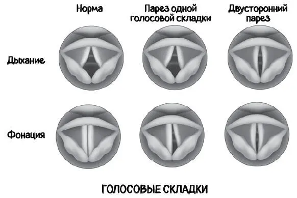 Чаще всего осиплостью страдают люди которые используют свой голос в профессии - фото 42
