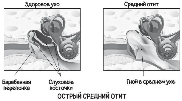У новорожденных и у маленьких детей диагностика среднего отита может вызывать - фото 11