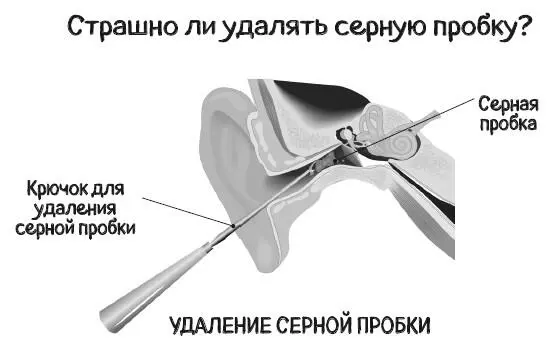 Образование серных пробок также может провоцировать частое использование беруш - фото 31