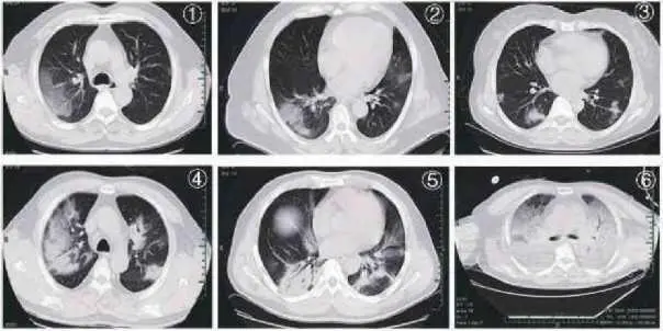 Характерные признаки COVID19 на снимках КТ Рис 1 Рис 2 очаговые - фото 11