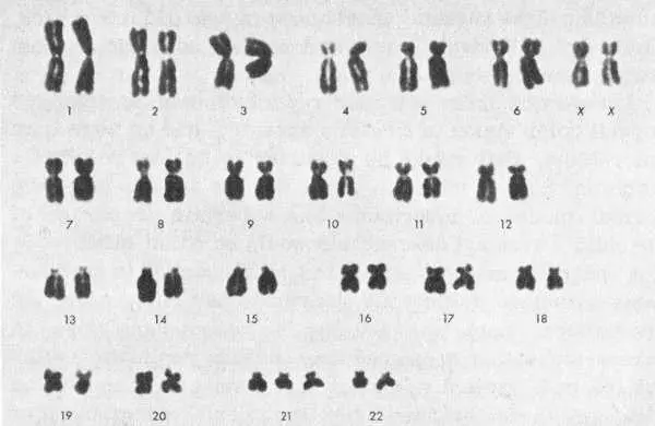 Karyotype of a female patient with Downs syndrome Mongolism During meiosis - фото 10