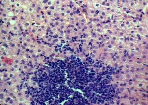 Рисунок 22 HCV умеренной степени активности лимфоидная инфильтрация - фото 28