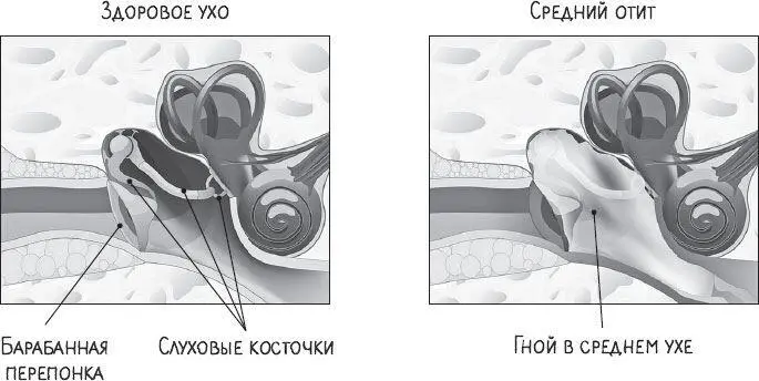 ОСТРЫЙ СРЕДНИЙ ОТИТ 3 повышение температуры тела 4 гнойные выделения из уха - фото 6