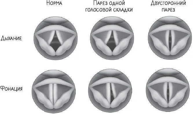 ГОЛОСОВЫЕ СКЛАДКИ На профессиональном языке любое нарушение голоса громкости - фото 18