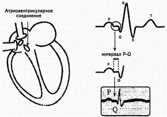 Рис 6 Происхождение интервала РQ 14 Зубцы Q Rи S Продолжая свой путь - фото 6