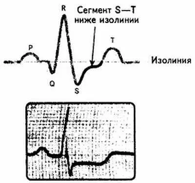 Рис 14 Сегмент SТниже изоэлектрической линии 2 Понятие времени - фото 14