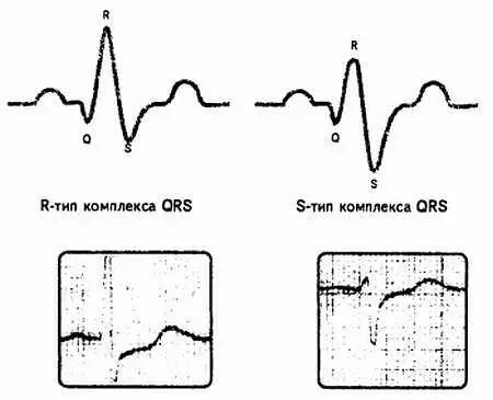 Рис 33 Визуальное сопоставление зубцов Rи Sко мплекса QRS Если на - фото 33