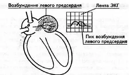 Рис 4 Возбуждение левого предсердия и его графическое изображение Отображая - фото 4
