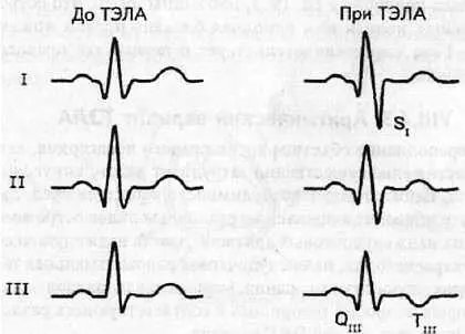 Рис 101 Электрокардиографический синдром S I Q III T III Особо значимыми - фото 95