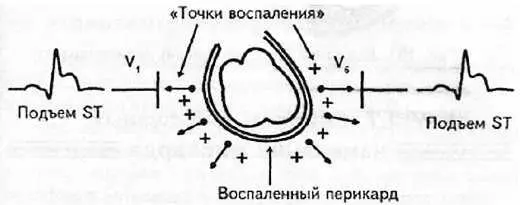 Рис 102 Фибринозный сухой перикардит Симптоматика сухого перикардита боль - фото 96