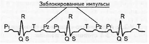 Рис 58 Неполная атриовентрикулярная блокада 2й степени Мобитц 2 21 - фото 52