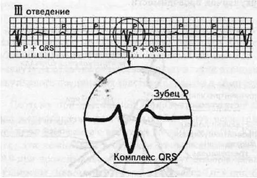 Рис 61 Все признаки полной атриовентрикулярной блокады В III отведении - фото 55