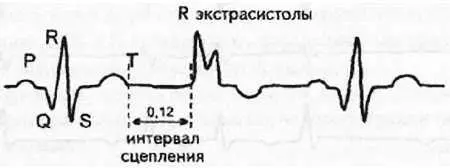 Рис 73 Интервал сцепления Если интервал сцепления экстрасистолы больше 012 - фото 67