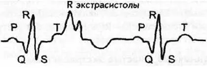 Рис 74 Экстрасистола Rна Т 8 Монотопные и политопные экстрасистолы - фото 68
