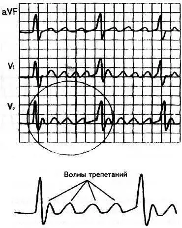 Рис 80 Трепетание предсердий VI32 Трепетание желудочков Трепетание - фото 74