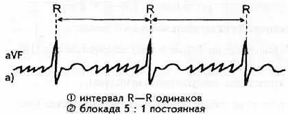 Рис 82 Регулярная форма трепетания предсердий Однако в ряде случаев - фото 76