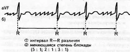 Рис 83 Нерегулярная форма трепетания предсердий VI4 Мерцание предсердий и - фото 77
