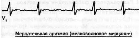 Рис 86 Мелковолновое мерцание предсердий Рис 87 Крупноволновое мерцание - фото 80