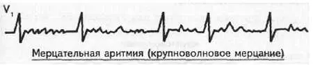 Рис 87 Крупноволновое мерцание предсердий 2 ЧСС при мерцательной аритмии - фото 81