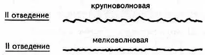 Рис 88 Фибрилляция желудочков Глава VII ЭКГ при инфаркте миокарда Одной из - фото 82