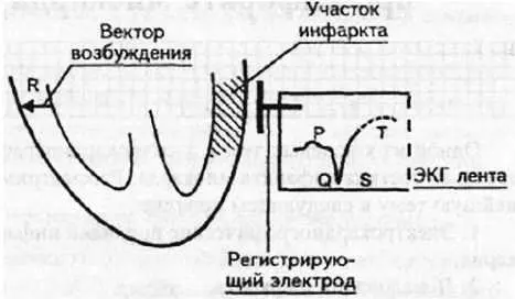 Рис 90 Возбуждение при инфаркте миокарда Первый ЭКГ признак отсутствие - фото 84