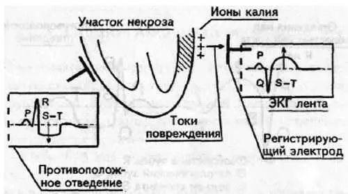 Рис 91 Токи повреждения Электрод над зоной инфаркта отобразит токи - фото 85