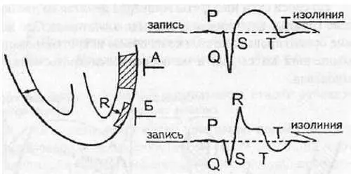 Рис 97 Крупноочаговые инфаркты миокарда На приведенном рисунке видно что - фото 91
