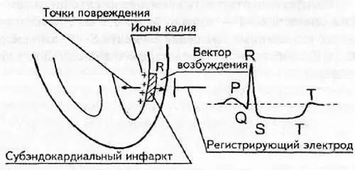 Рис 98 Субэндокардиальный инфаркт миокарда При этом инфаркте величина - фото 92