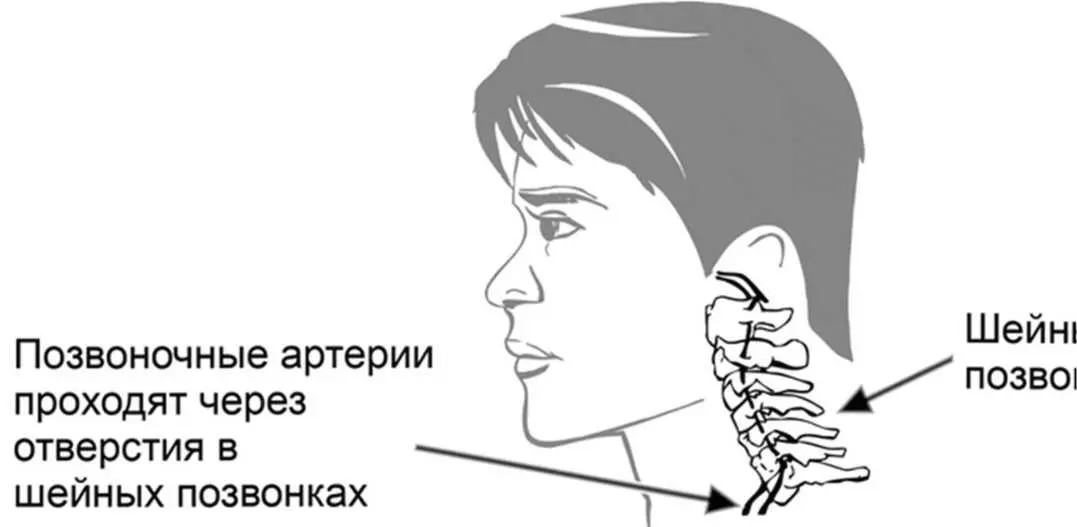 При остеохондрозе один или несколько шейных позвонков смещаются и пережимают - фото 1