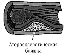 Образование бляшки в артерии ведет к её склерозированию закупориванию - фото 15