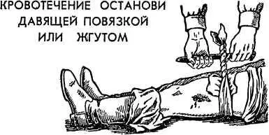 Рис 35 Жгут нужно периодически ослаблять Если кровотечение сильное и - фото 37