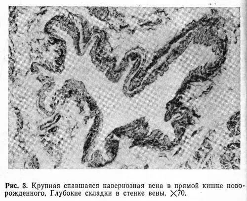 Следует отметить что один из главных отличительных признаков кавернозных - фото 7