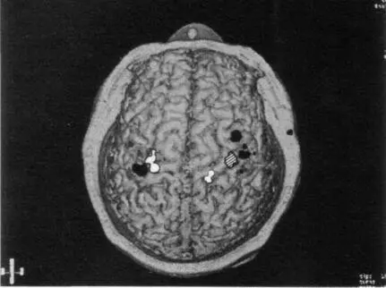 Figure 23 Magnetoencephalography MEG image superimposed on a magnetic - фото 6