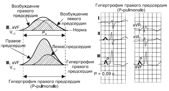 Рис 310Формирование зубца P при гипертрофии правого предсердия Рис - фото 14
