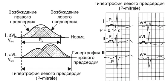 Рис 311Формирование зубца P при гипертрофии левого предсердия В норме - фото 15