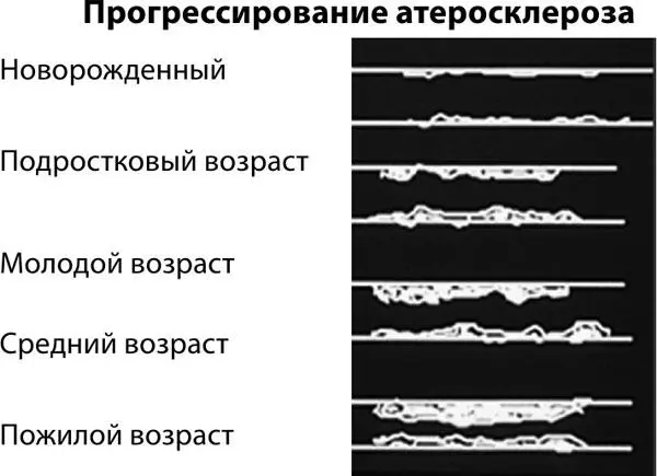 Рисунок 19 Прогрессирование атеросклероза в зависимости от возраста - фото 23